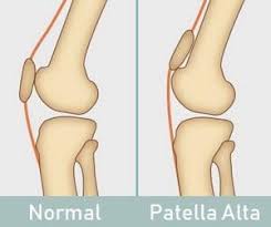 Image result for Patella Mobility Test