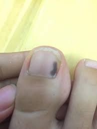 足の爪に黒い斑点 中学生です 足の爪に黒い斑点ができました 気づい 怪我 教えて Goo