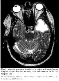 Misra uk, hashmi aa, kalita j. Tony Breu On Twitter 1 15 Why Does Herpes Simplex Virus Type 1 Hsv 1 Encephalitis Localize To The Temporal Lobe There Are So Many Brain Structures And Yet The Virus Has A Tropism
