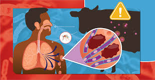 Image result for Anthrax