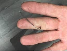 Image result for Fishhook Removal