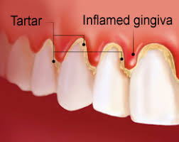 Then you may have a condition called gingival swelling. Swollen Gums Around A Tooth Causes And Remedies The Smile Practice