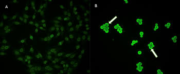 Image result for ANA Staining Pattern