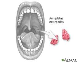 Image result for Tonsillectomy