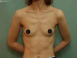 40代女性・授乳後のしぼんだバストに】ピュアグラフト豊胸（3ヶ月後） - 症例写真 - 美容整形、美容外科なら聖心美容クリニック