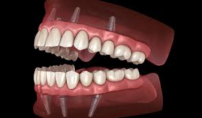Maybe you would like to learn more about one of these? Implant Supported Dentures Voss Dental Oral Surgery Implant