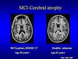 Mci Cerebral Atrophy