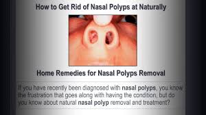 How to remove nasal polyps? How To Get Rid Of Nasal Polyps At Naturally Home Remedies For Nasal Polyps Removal Youtube
