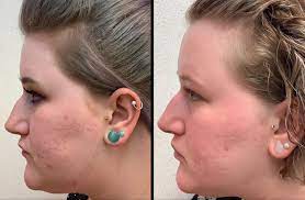 I have non alcoholic fatty liver disease. How To Get Rid Of Acne Scars My Journey With Accutane Lovelyskin
