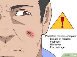 Leave acne to the experts — get acne care from a real provider with 1 short quiz. How To Heal Scabs On Your Face 9 Steps With Pictures Wikihow