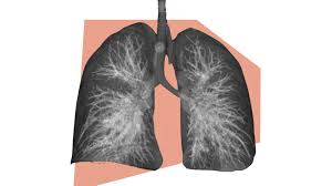 They are not liver cells that have become cancerous. Breakthrough Study Finds Ct Scanning Can Detect Most Lung Cancer Cases Early The Swaddle