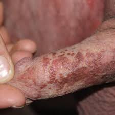 I had a little bump on my penis which when i pressed, very little pus came out of it. Brown Papules On The Penis Mdedge Dermatology