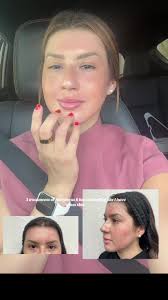 Morpheus 8 Results After 3 Treatments