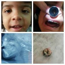 Complications of Button Battery in the Nose and Preventions in Karbala