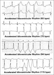 Accelerated junctional rhythm occurs when the av junction fires impulses at above 60 bpm. What Does Accelerated Junctional Rhythm Mean