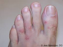 To identify fire ant stings, look for groups of swollen red spots that develop a blister on the top. Fire Ant Bites American Osteopathic College Of Dermatology Aocd