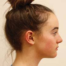 ALF, Twin Block, Straight Wire for Linear Scleroderma Treatment