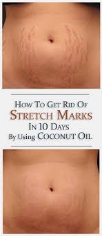 How To Get Rid Of Stretch Marks By Using Coconut Oil 18aims Coconut Oil Stretch Marks Stretch Marks Oil For Stretch Marks
