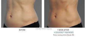 Check spelling or type a new query. Cooltone Before And After Pictures Real Patient Results