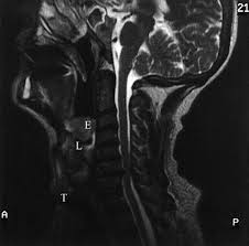 Image result for Epiglottitis