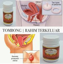 Ia disebabkan proses pengecutan rahim. Peranakan Rahim Terkeluar Ratu Manjakani Asli Kapsul Facebook