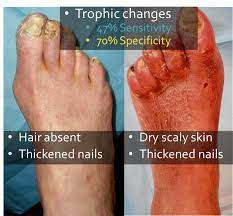 Clinical Evaluation Of The Foot For Peripheral Arterial Disease | Michael  Cumming, Md, Mba