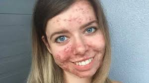 Pas plus tard qu'hier, je suis tombée sur une vidéo de marie, que la plupart connaissent sous le pseudo enjoyphoenix. Pour Donner Du Courage Aux Femmes Elle Devoile Son Visage Touche Par L Acne Depuis Qu Elle A Arrete La Pilule