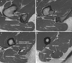 An os acromiale must be. Total Proximal Hamstring Ruptures Clinical And Mri Aspects Including Guidelines For Postoperative Rehabilitation Springerlink