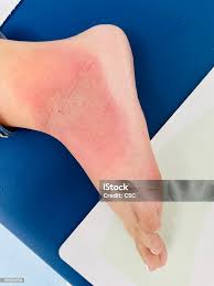 Image result for erysipel photos)