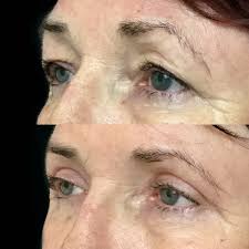 Every eyelid flip is a count down. Eyelid Reduction Dr David Sharp Plastic Reconstructive Cosmetic Surgeon