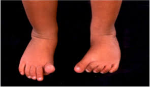 Image result for Out-toeing