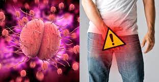 A new strain of gonorrhea with resistance to antibiotics is spreading |  Canada