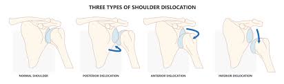 Image result for Shoulder Instability Exam