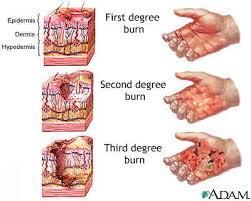 Everyone Should Know This Healing Miracle For Burns First Aid Consists To Spraying Cold Water On The Affecte Burns Treatment Burn Injury Nursing Care Plan