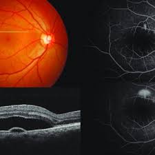 It is possible that fluid may build up in areas that are not around the macula, which is responsible for clear central vision. Pdf Review And Update For Central Serous Chorioretinopathy