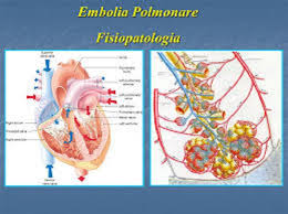 L'embolia polmonare è, generalmente, causata da un coagulo di sangue, anche se la formazione di emboli e l'ostruzione arteriosa possono originare anche la diagnosi di embolia polmonare si basa spesso sulla verifica della presenza di un'ostruzione dell'arteria polmonare mediante angiografia con. Come Prevenire L Embolia Polmonare