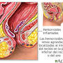 estreñimiento "heces duras" sangrado de ssl.adam.com