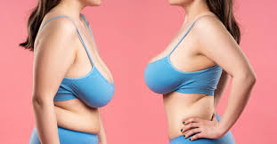 How Long Is Recovery From Breast Reduction? | Bizrahmed