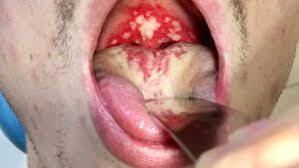 Image result for Physical injury red spots roof of mouth