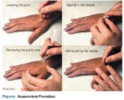 Understanding The Benefits Of Acupuncture Treatment For Cancer Pain Management