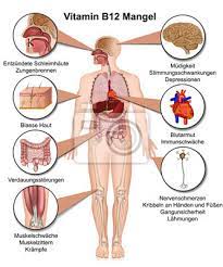 Vitamina D Mangel Anzeichen Und Symptome Ilustracao Vetorial Pinturas Para A Parede Quadros Esclerose Alta Pressao Arterial Escassez Myloview Com Br