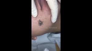 I was busy thatswhy i was not uploading the videos. Newsflare Super Blackhead Removal On The Face