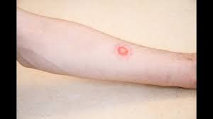 How long does it take to fully cure ringworm? Ringworm Signs And Symptoms