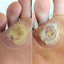 Treatment can help a wart clear more quickly. Wart Dead Skin Removal Facial Scrub