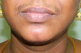 What causes skin and hair issues in women with pcos? Young Women Battling Polycystic Ovarian Syndrome Pcos Guyana Chronicle