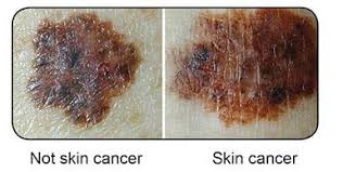 Your doctor can perform the test in their office or may decide that a telemedicine visit is more appropriate. Dermtech Offers A Simple Way To Detect Melanoma Melanoma Research Victoria