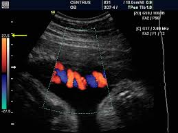 It is used for stroke prophylaxis and the clarification of circulatory. Doppler Ultrasound Principles And Practice