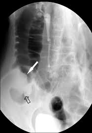 Image result for Adult Intussusception