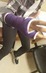 Image result for Ulnar Gutter Cast