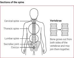 A bone spur is a small, sharp outgrowth of bone. Ankylosing Spondylitis Symptoms Causes Treatments